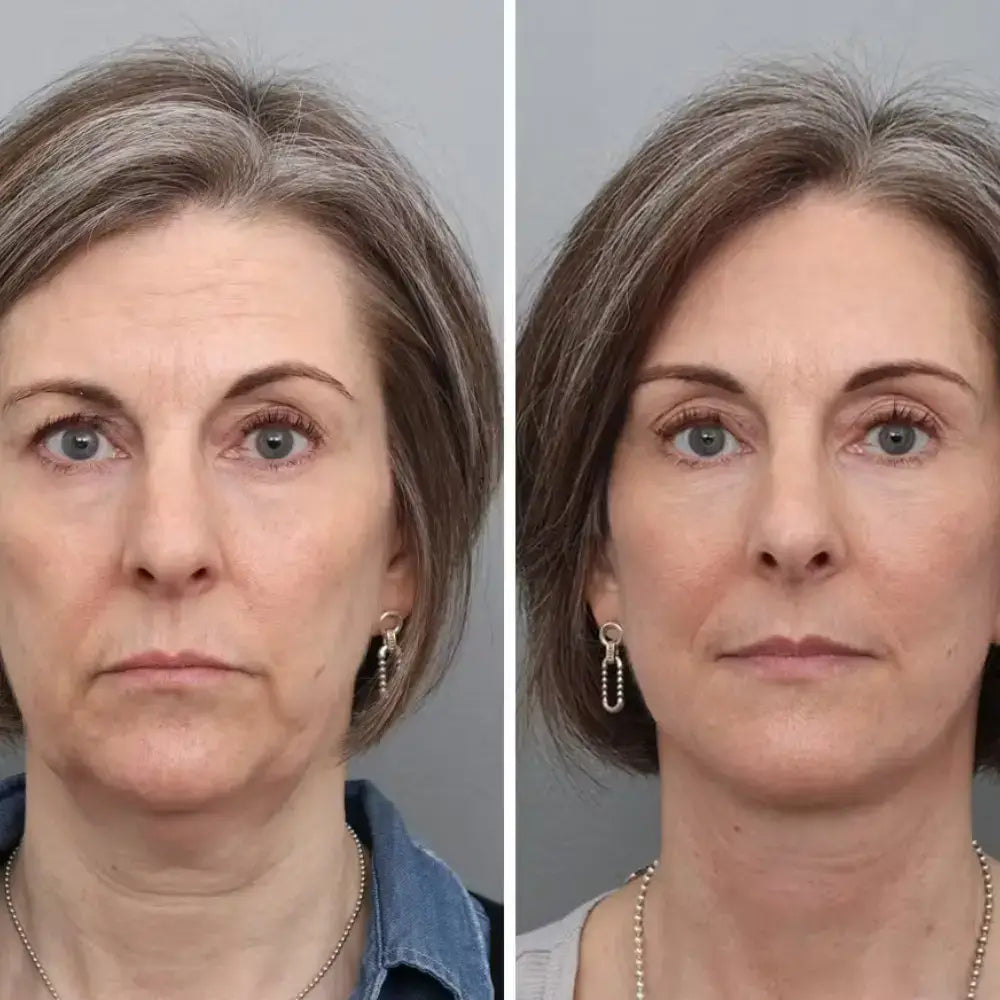 30 days of using oak and aura pro sculpt device